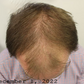 ATTDX HairReborn Minoxidil Growth Roller
